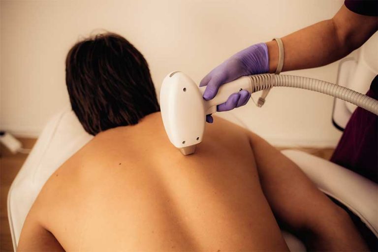 Depilasión-laser-en-espalda-para-hombre