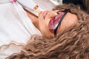 depilacion-laser-menton